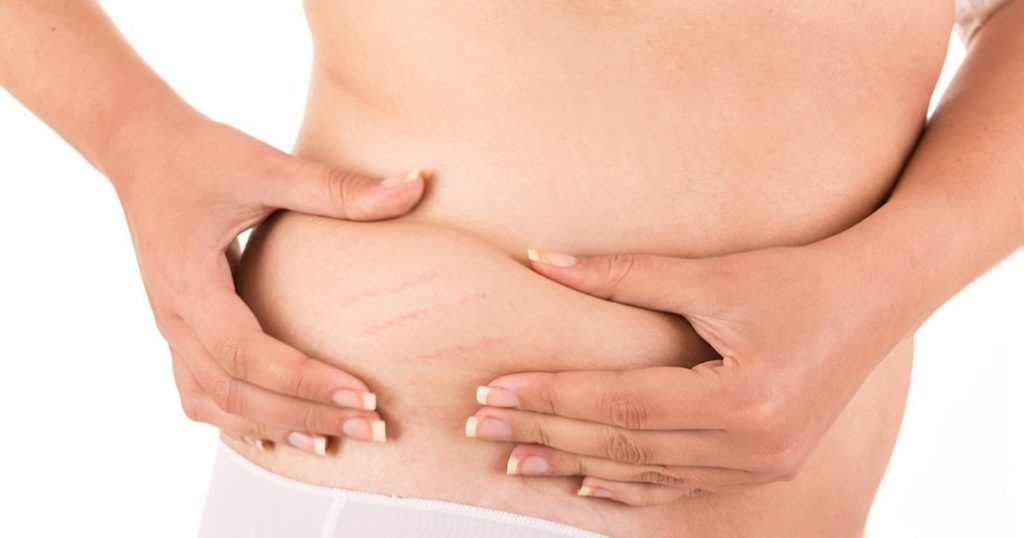 stretch mark removal 1030x541 1024x538