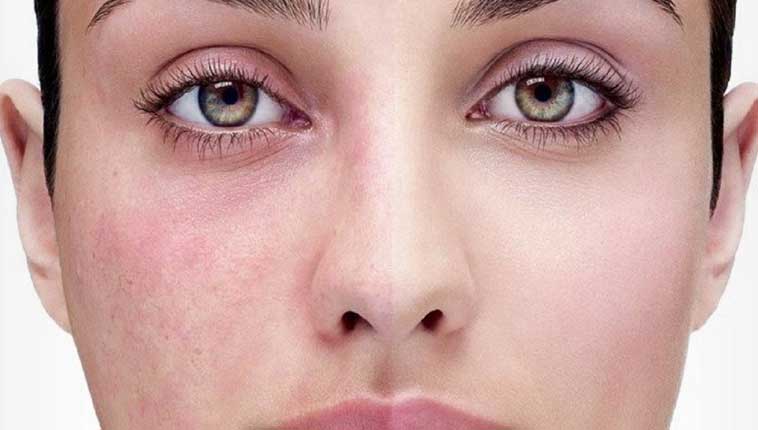 rhofade new rosacea medicine